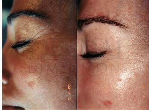 Microdermabrasion